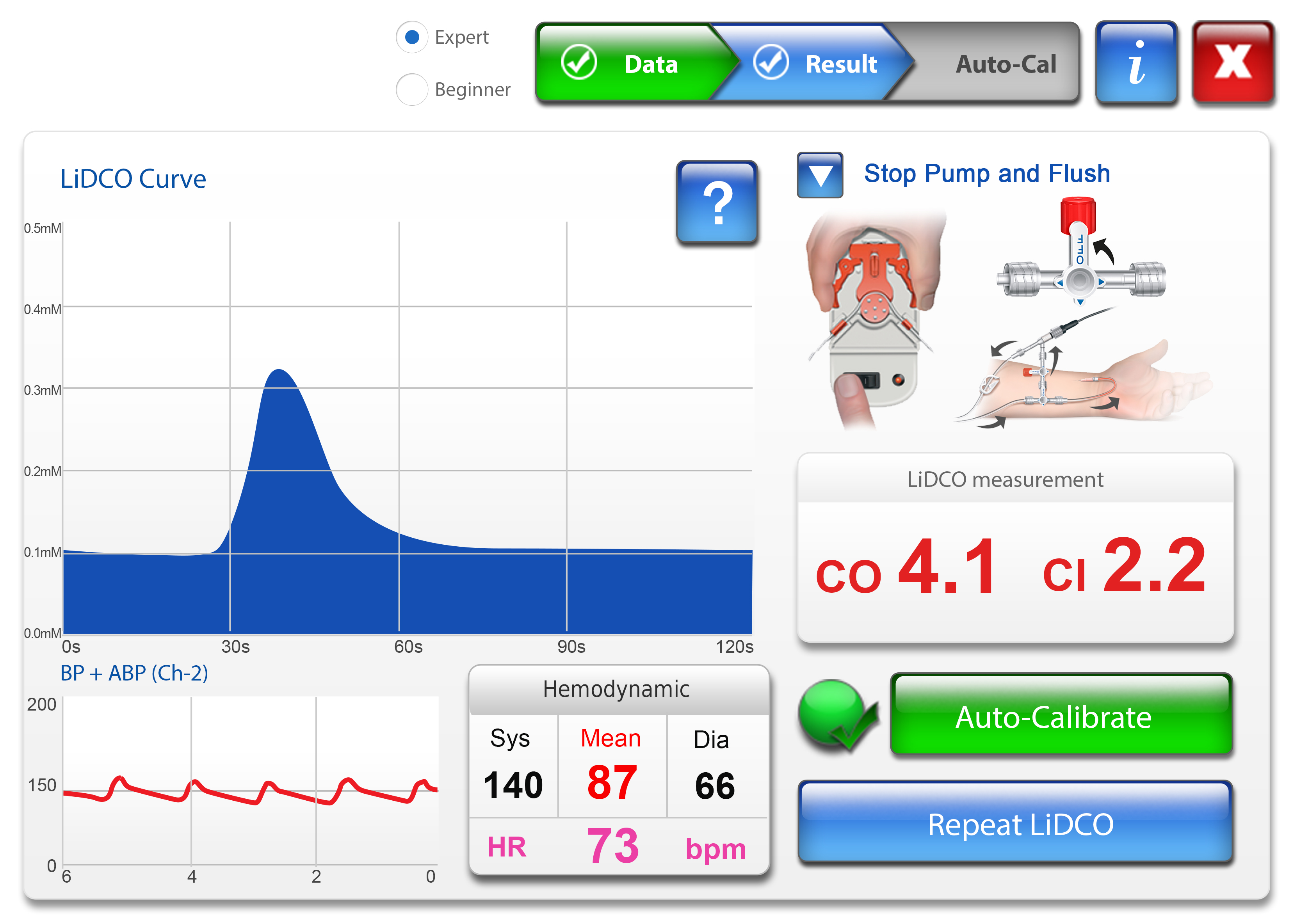 Calibrated V Lidco Hemodynamic Monitoring For The Entire Patient