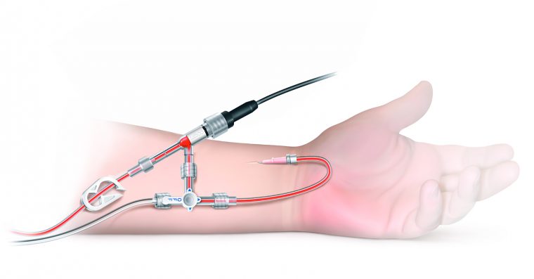 Calibrated V Lidco Hemodynamic Monitoring For The Entire Patient